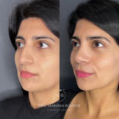 Rinoplastia - Dra. Mariana Bouvier