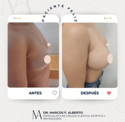 Aumento Mamario - Dr. Marcos F. Alberto