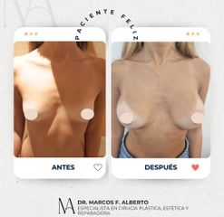 Aumento Mamario - Dr. Marcos F. Alberto