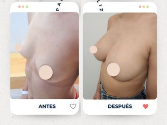 Aumento mamas antes y después - 875027