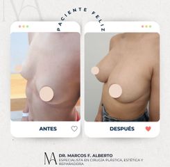 Aumento Mamario - Dr. Marcos F. Alberto