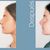 Rinoplastia y septumplastia